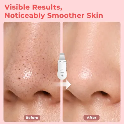Ultrasonic Shovel BEAUTY START - Skin Scrubber, Face Spatula For Blackhead Removal And Cleansing Pores_img_14