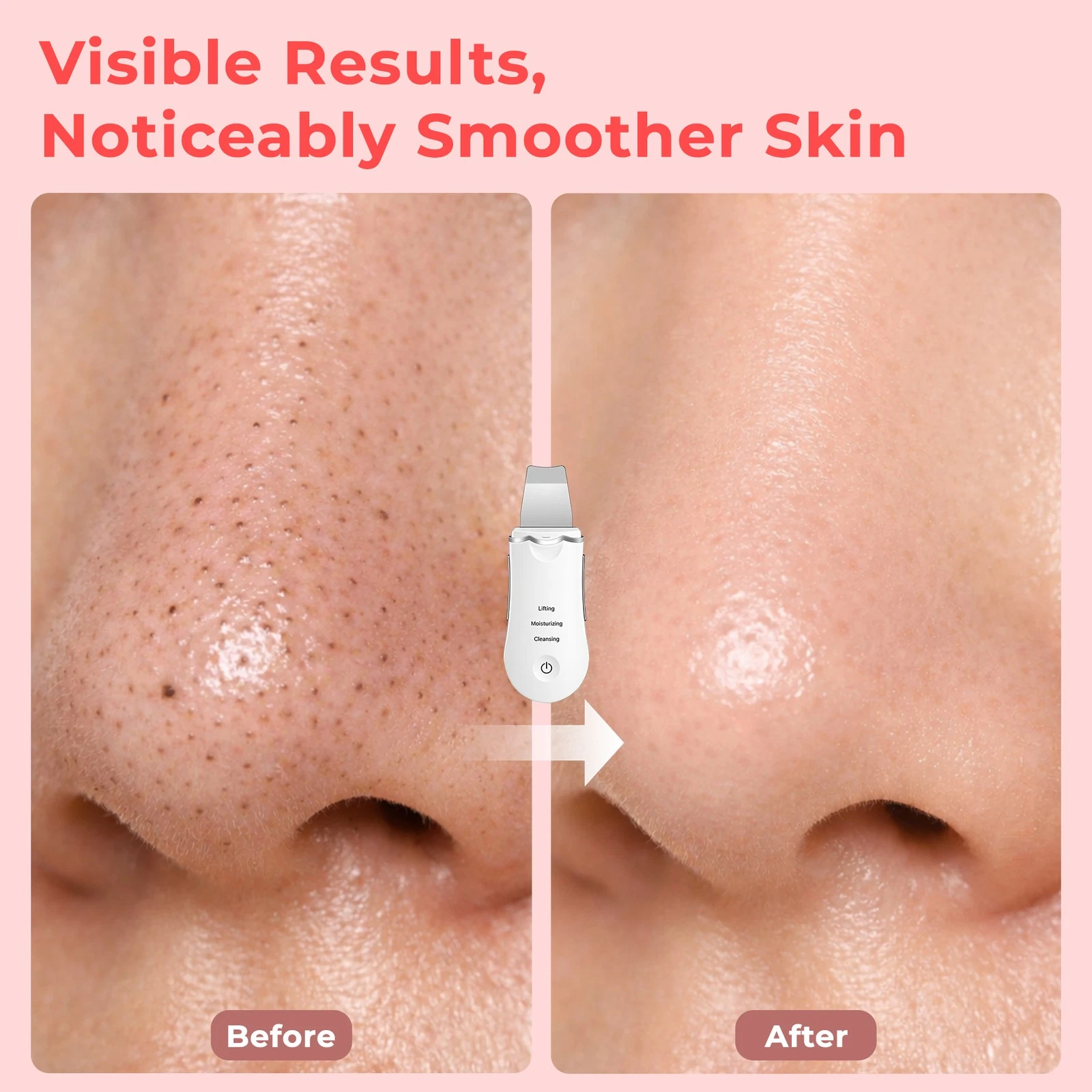 Ultrasonic Shovel BEAUTY START - Skin Scrubber, Face Spatula For Blackhead Removal And Cleansing Pores_img_14
