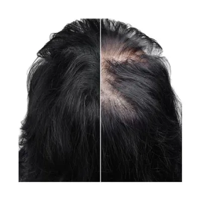 PLURYAL MESOLINE HAIR_img_1