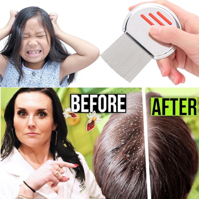 Stainless Steel Lice Removal Comb Anti Lice Nit Comb Hair Dandruff Cleaning Comb thumbnail 2
