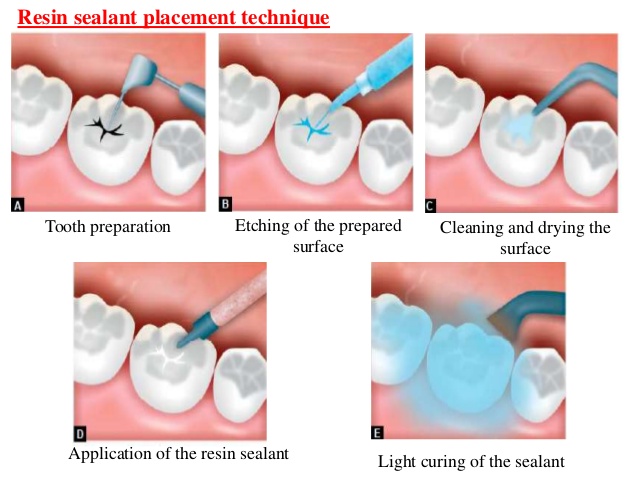 pits and fissure sealant