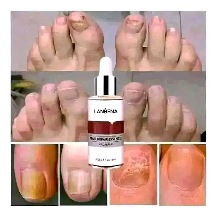 LANBENA Nail Repair Essence Serum-15ml_img_1