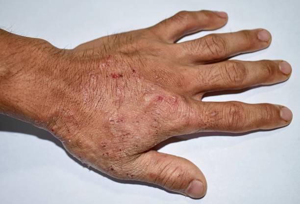 Scrabel Permethrin Soap [Indian] চুলকানি চিকিৎসায়_img_6