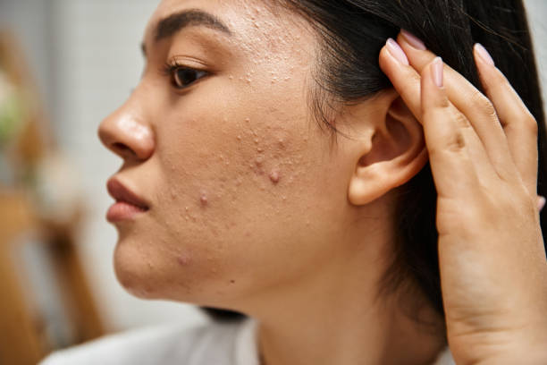 Acnetoin [Indian] Anti Acne Soap ( ব্রণের চিকিৎসায়)_img_4