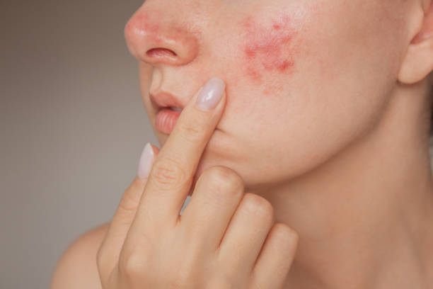 Acnetoin [Indian] Anti Acne Soap ( ব্রণের চিকিৎসায়)_img_8