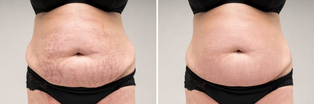Anti Stretch Mark Cream [ মাতৃত্বের দাগ চিকিৎসায় ]_img_1