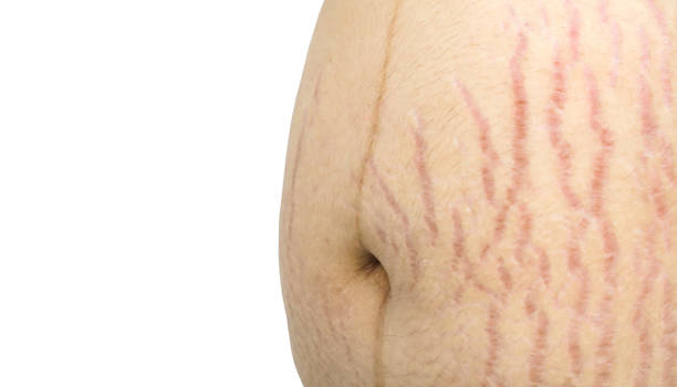 Anti Stretch Mark Cream [ মাতৃত্বের দাগ চিকিৎসায় ]_img_3