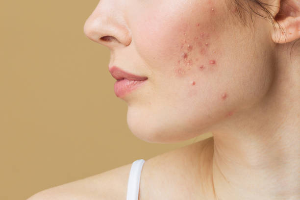 Acnetoin Plus [ Indian ] ব্রণের জীবানু ধ্বংসকারী_img_3