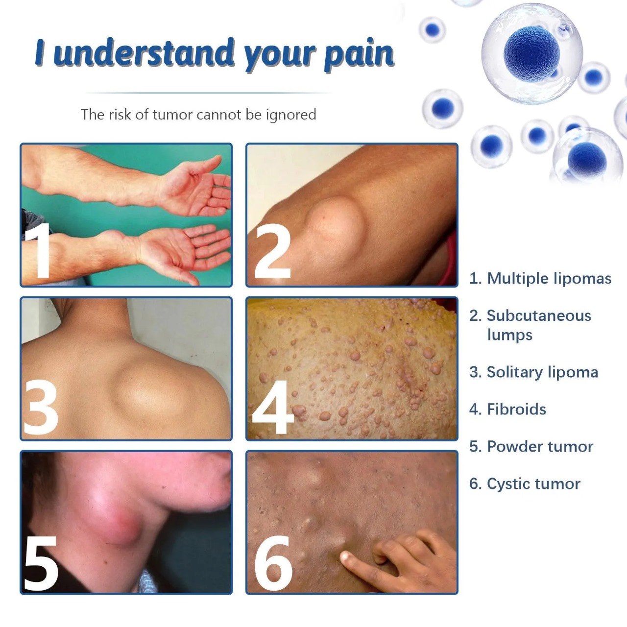 South Moon - Lipoma Remover Spray Relief Lipolysis Fat Lump With Lipoma Spray 50 ml_img_2
