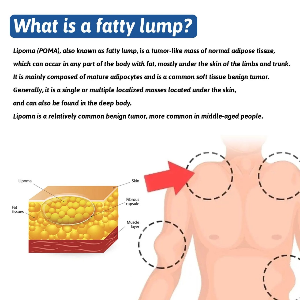 South Moon - Lipoma Remover Spray Relief Lipolysis Fat Lump With Lipoma Spray 50 ml_img_3