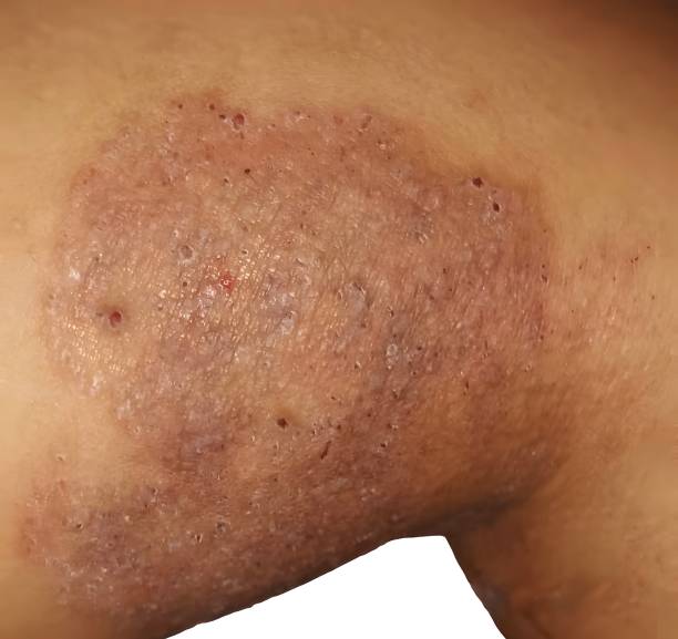 Ketosclap Soap [ Indian ] শক্তিশালী এন্টিফাংগাল_img_4
