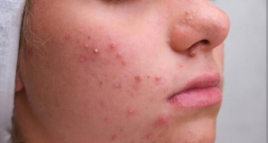 Acne Star - Benzoyel Peroxide soap [ Indian ]_img_4