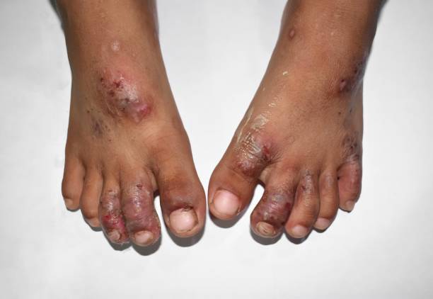 Permimite Lotion [Indian] চুলকানি ধ্বংসকারী এবং উকুননাশক_img_9