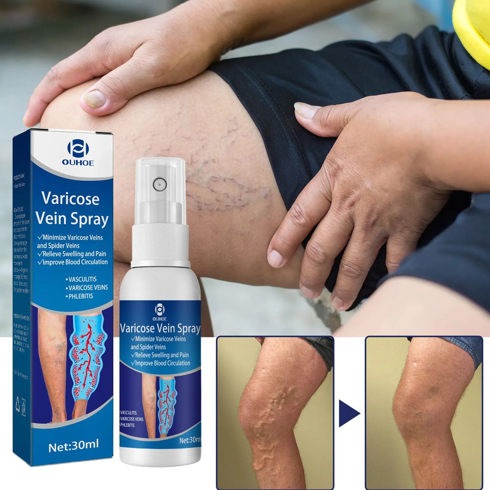Varicose Vein Relief Spray – ভ্যারিকোজ ভেইন, স্পাইডার ভেইন ও পায়ের ফোলা কমানোর হার্বাল স্প্রে