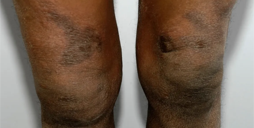 Clop G Cream [ একজিমা, দাগ চিকিৎসায় ]_img_5