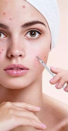 Blackhead/Whitehead/Pimple Removal Tools