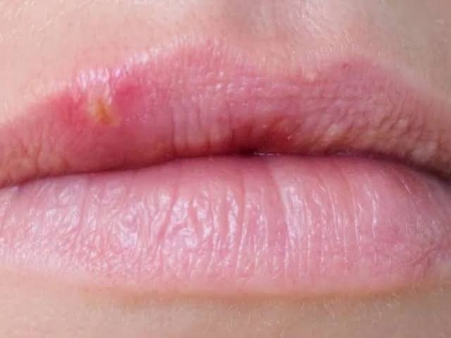 Lip Bumps